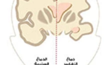 وش اسوي : الزهايمر