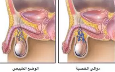 وش اسوي : دوالي الخصية – Varicocele