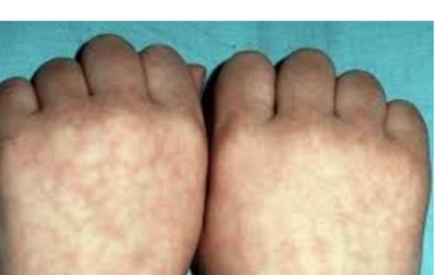 وش اسوي : التزرق الشبكي – Livedo reticularis