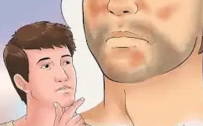 وش اسوي : التهاب الجلد الدهني – Seborrheic dermatitis