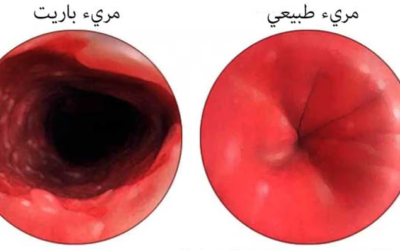 وش أسوي: مريء باريت