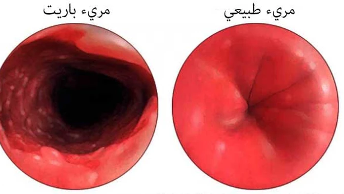 وش أسوي: مريء باريت