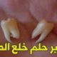 تفسير حلم خلع الضرس في المنام للعزباء والمتزوجة والرجل