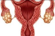 وش اسوي : داء المبيض أسبابه، أعراضه، وطرق العلاج
