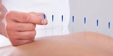 وش أسوي: العلاج بالوخز بالإبر