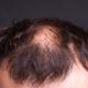 علاج الصلع المبكر وأسباب حدوثه