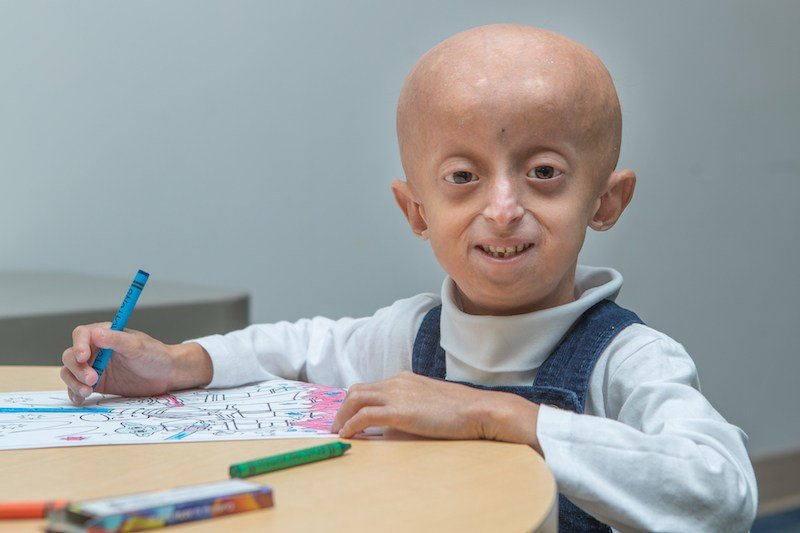 ما هي الشيخوخة المبكرة عند الأطفال
